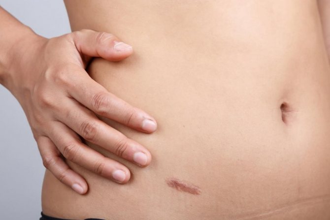 2835079 - What does a scar look like after appendicitis?