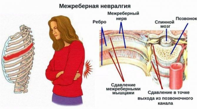 Anatomy of intercostal neuralgia