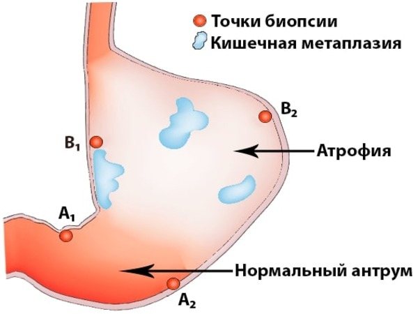 Биоптат слизистой желудка. Аутоиммунный атрофический гастрит. Аутоиммунные процессы при гастрите. Биопсия слизистой желудка.