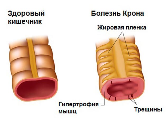 Crohn&#39;s disease