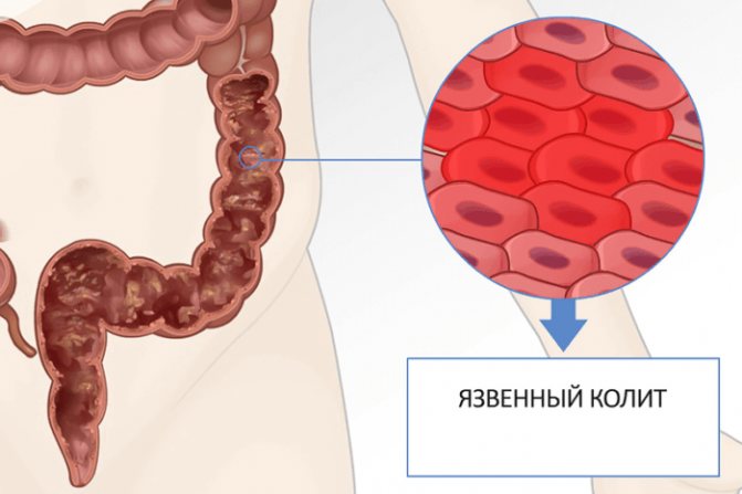 pain in the lower abdomen on the right side in men - ulcerative colitis