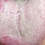 What to do if there is a white coating on the tongue?