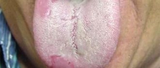 What to do if there is a white coating on the tongue?