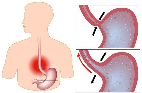 What is reflux - esophagitis