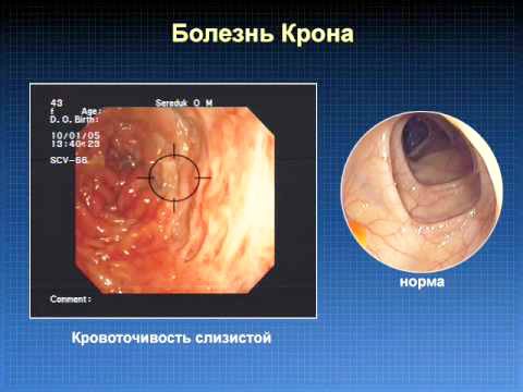 Diagnosis of Crohn&#39;s disease