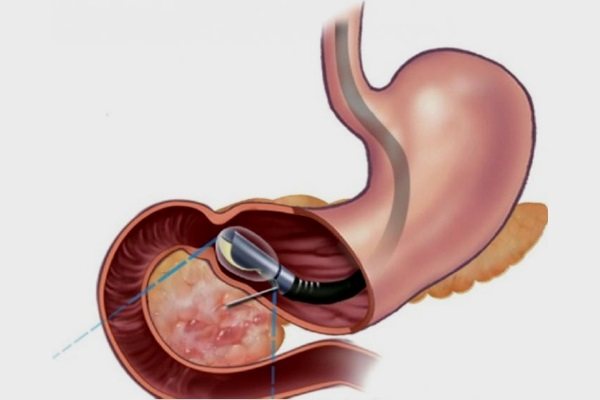Endosonography of the stomach