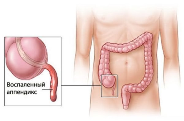 Where is appendicitis located in humans?