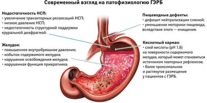 GERD (Gastroesophageal reflux). Symptoms and treatment, diet 