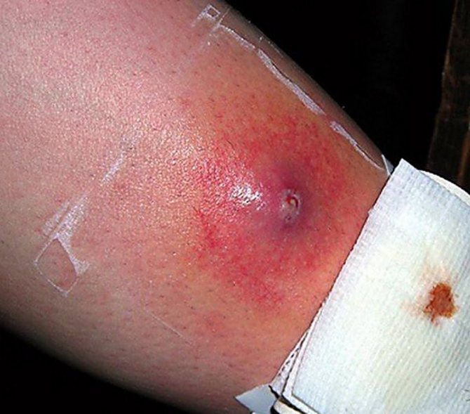 Гнойная рана при золотистом стафилококке