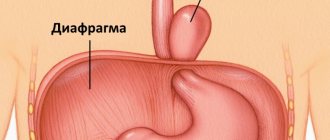 Diaphragm hernia: symptoms, causes, treatment methods, prognosis