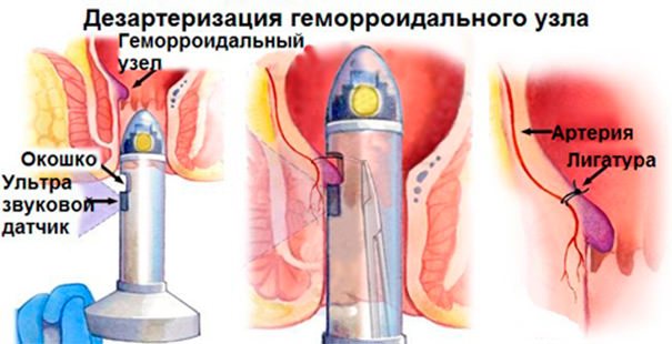 We get rid of an unpleasant illness with effective methods and treatment regimens for external hemorrhoids and prolapsed cones