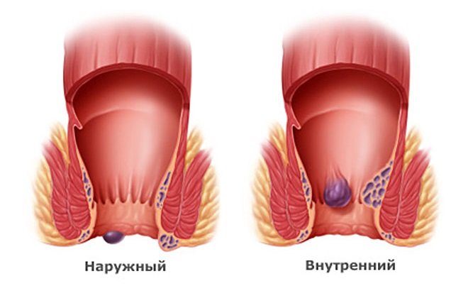 How to treat hemorrhoidal thrombosis at home