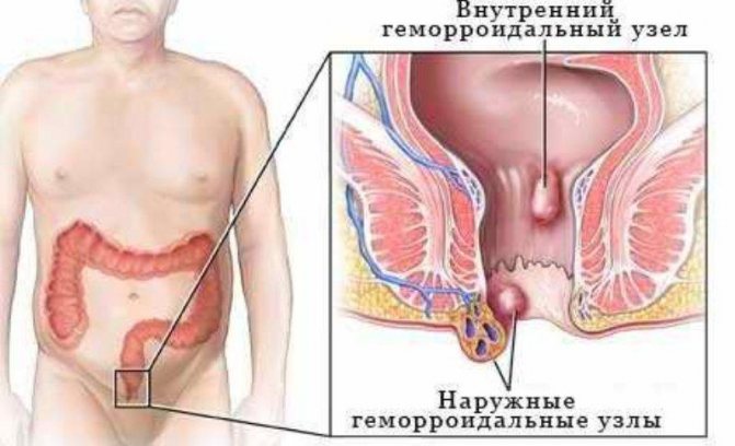 How to treat hemorrhoids with cold: instructions and reviews