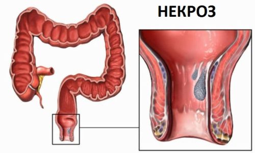 How to treat acute hemorrhoids: causes, symptoms and methods of treating an aggravated disease