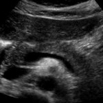 How to prepare for an ultrasound of the pancreas