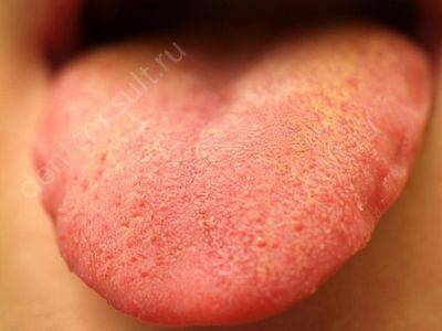 How to remove white plaque from the tongue with gastritis