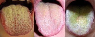 How to remove white plaque from the tongue with gastritis