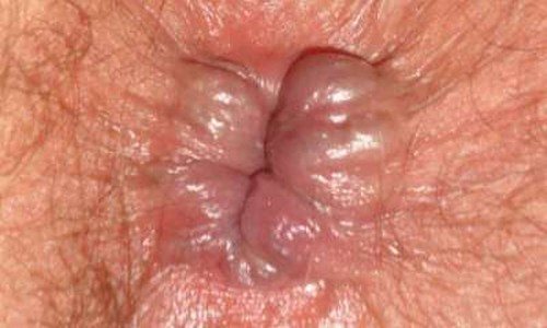 What does the initial stage of hemorrhoids look like?