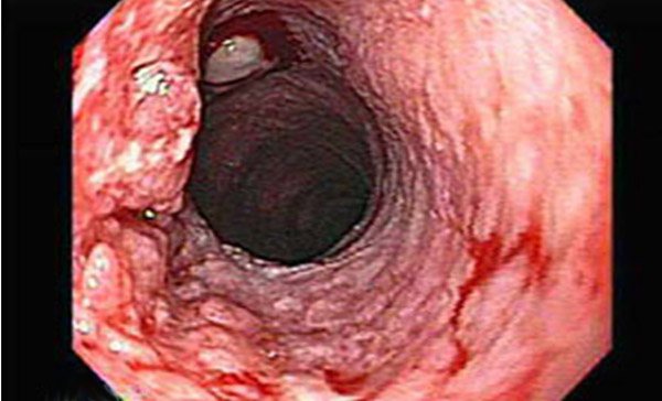 What does squamous cell nonkeratinizing esophageal cancer look like?