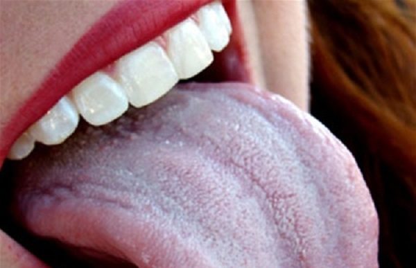 What does the tongue look like with gastritis photo
