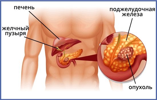 Carcinomatosis of the abdominal cavity. Treatment, what it is, symptoms, prognosis 