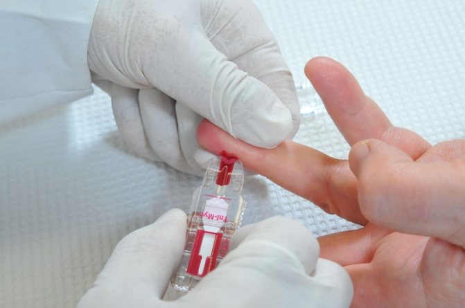 Клинический анализ крови при остром панкреатите назначается в качестве дополнительного обследования