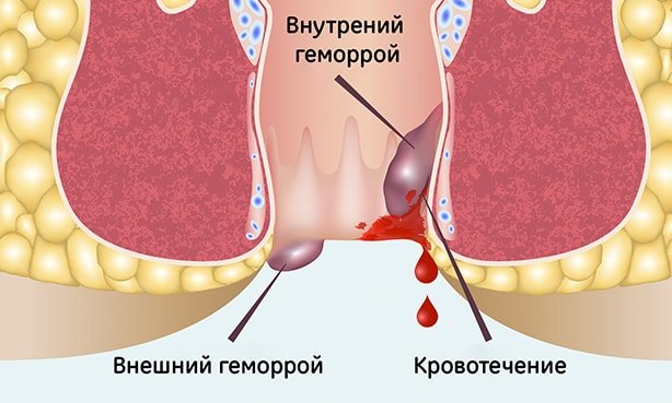 Кровотечение из внутренних геморроидальных шишек