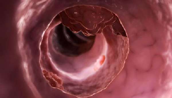 Intestinal tumor