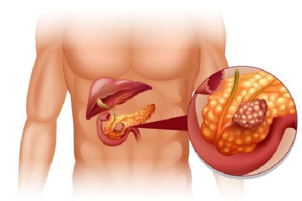 Tumor in the pancreas