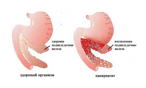 Pancreatitis is a likely cause of nausea