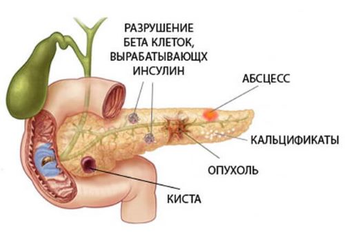 pancreatic pathology