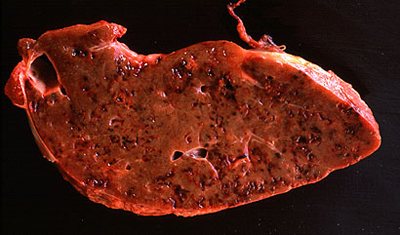 liver with opisthorchiasis photo