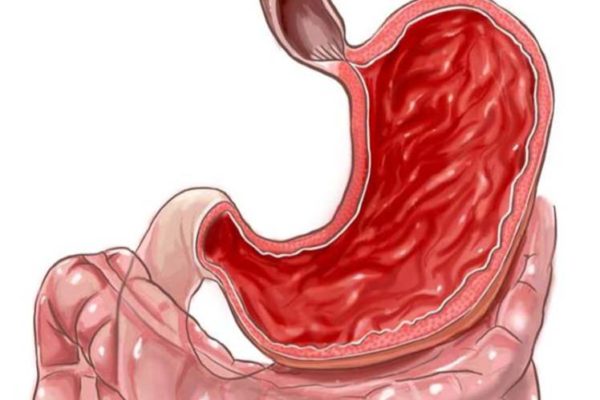 Why does a lump appear in the throat with gastritis?