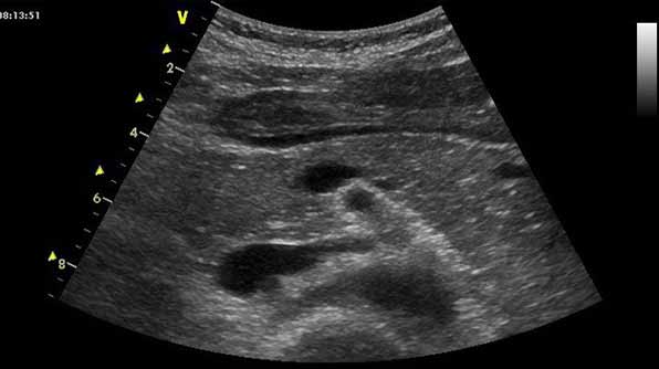 Pancreas on ultrasound