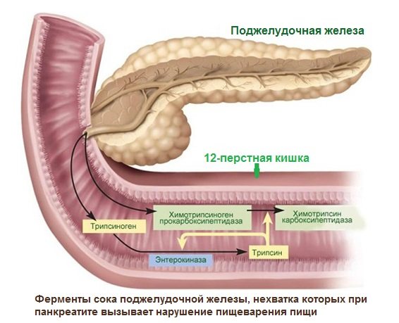 Diarrhea due to pancreatitis