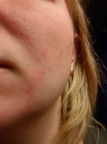 Последствия от ректального введения средства у аллергика может быть более опасным, чем от нанесения препарата на кожу.