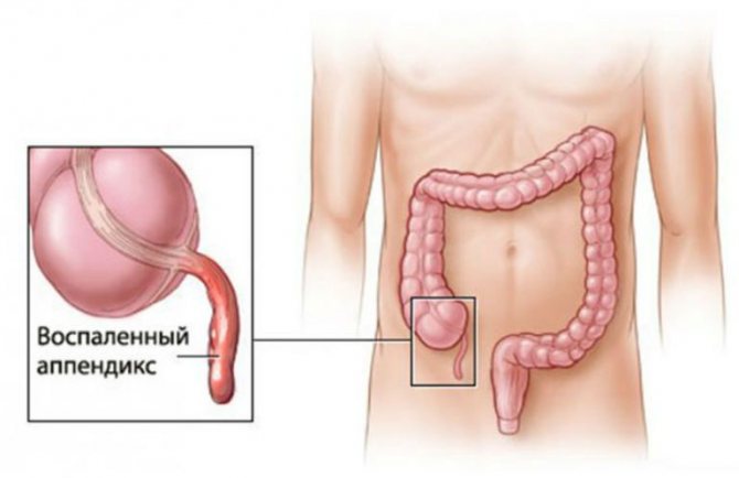 Signs of appendicitis in men, symptoms, description
