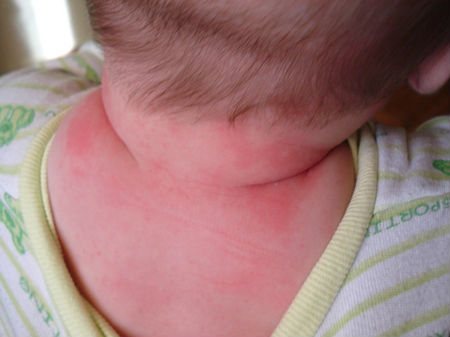 Signs of worms in a child
