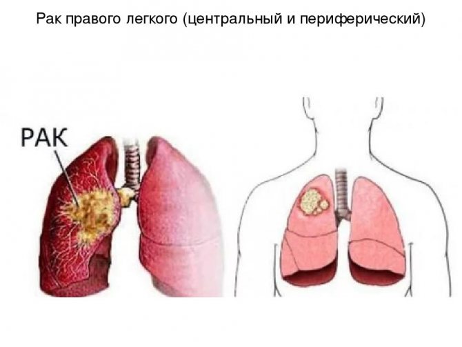 Cancerous tumor in the lung