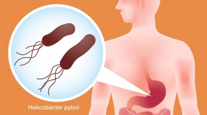 The development of erosive gastropathy is facilitated by the activation of the bacteria Helicobacter pylori in the patient’s body