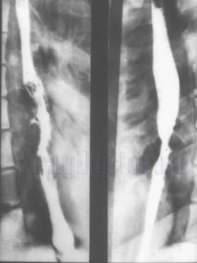 X-ray of the esophagus and stomach in the trendelenburg position