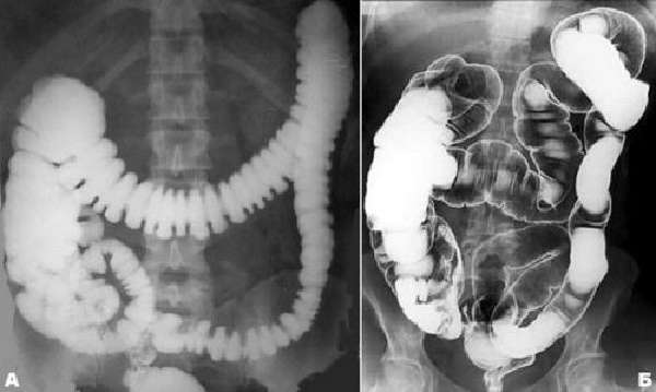 X-ray for constipation