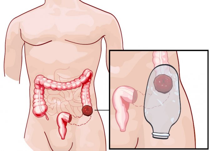 Rectal resection: types of operations. Surgery technique and treatment consequences 