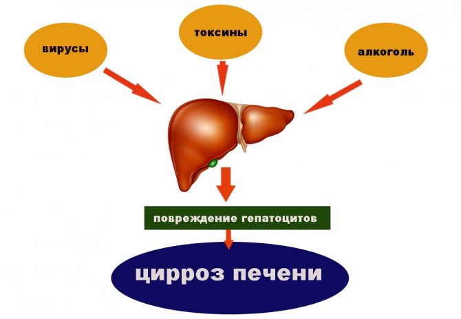 Diagram of liver cirrhosis