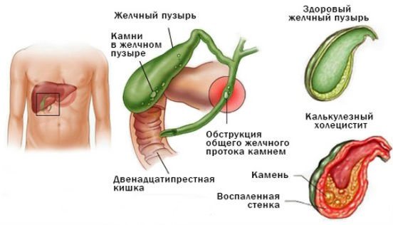 Symptoms and treatment of cholecystitis. Folk remedies, medicines, diet, antibiotics, herbs. Clinical guidelines 