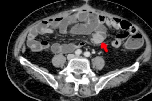 image of an organ with metastases