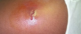 Стафилококк является причиной гнойного поражения кожи
