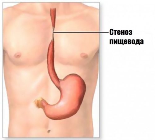 Narrowing of the esophagus is one of the causes of pain when swallowing