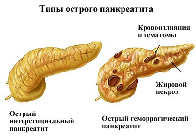 types of pancreatitis