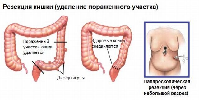 Exercises for diverticulosis of the sigmoid colon